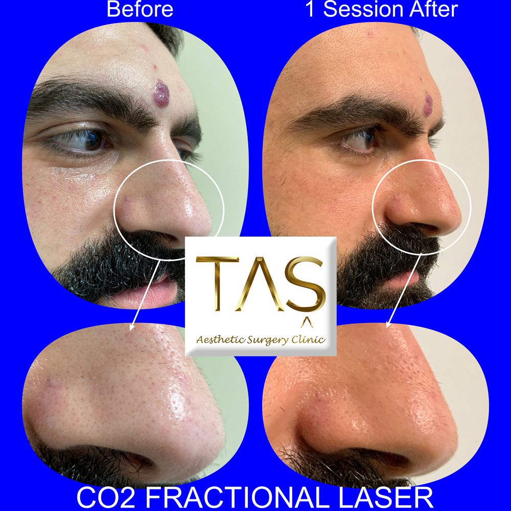 Fractional CO2 Laser • Tas Clinic
