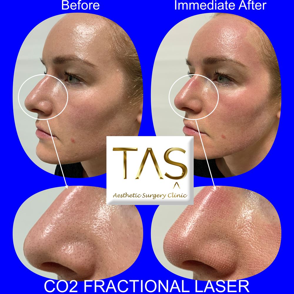 Fractional CO2 Laser Before and After Photos